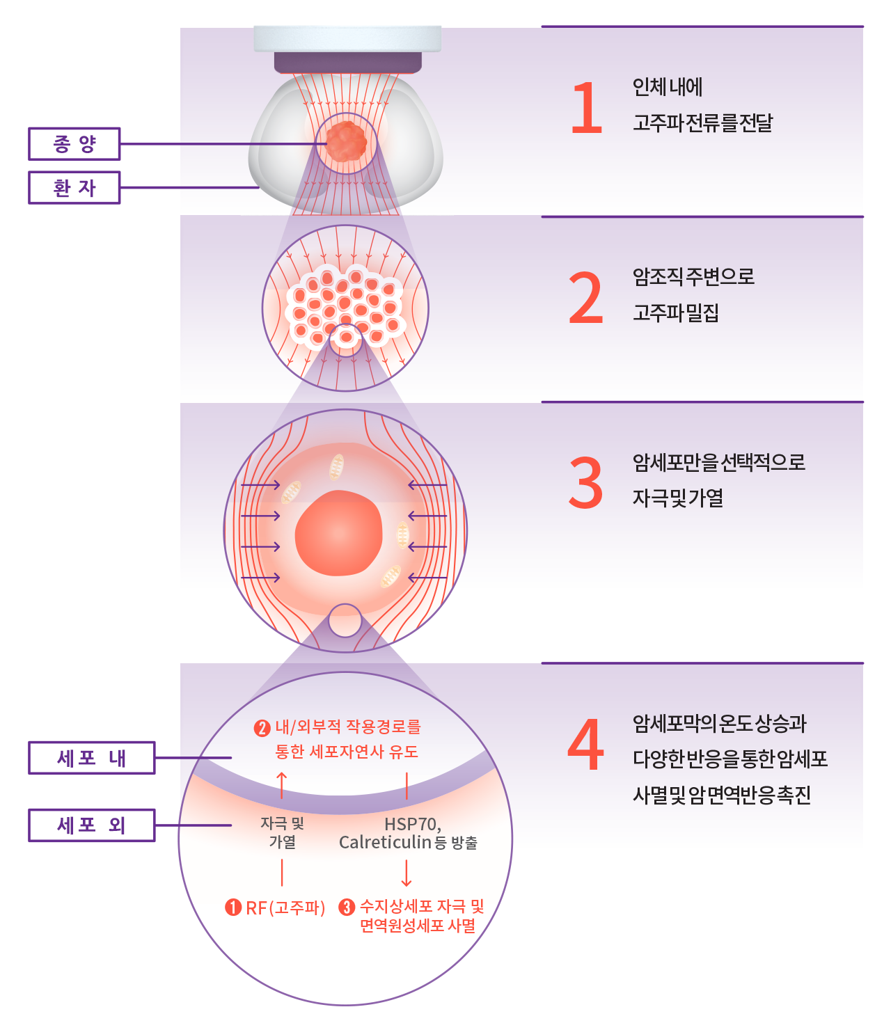 일반적 고주파 온열치료 방식 도식 이미지