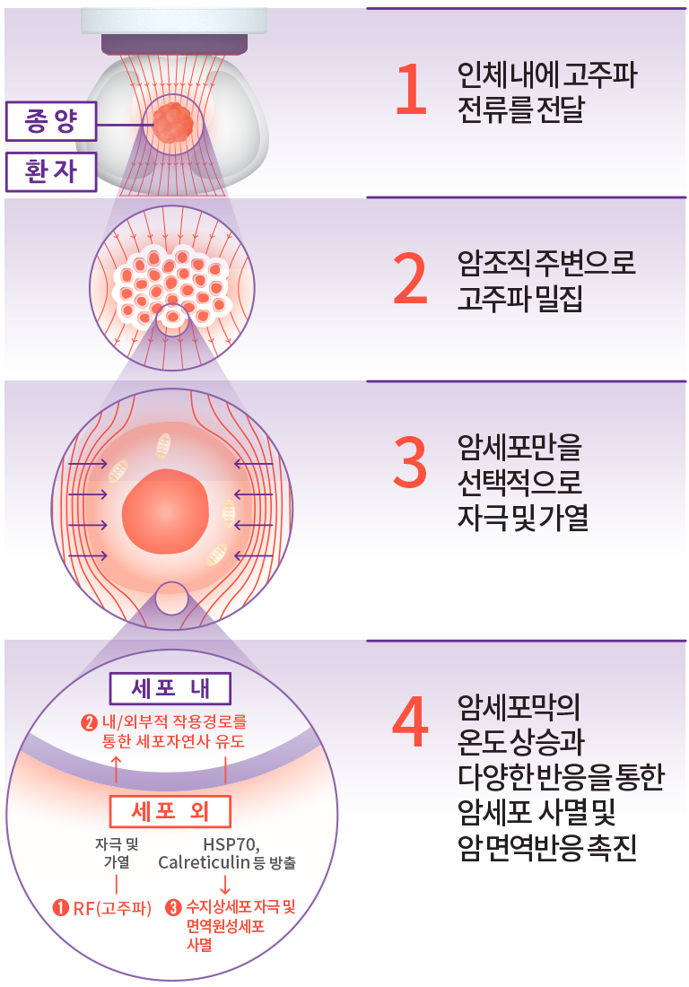 일반적 고주파 온열치료 방식 도식 이미지