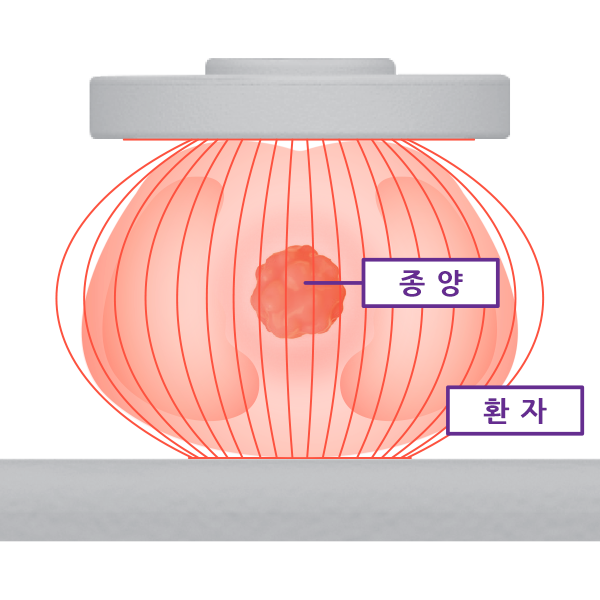 일반적 고주파 온열치료 방식 도식 이미지