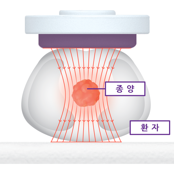 일반적 고주파 온열치료 방식 도식 이미지